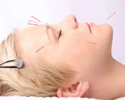 Acupuntura facial